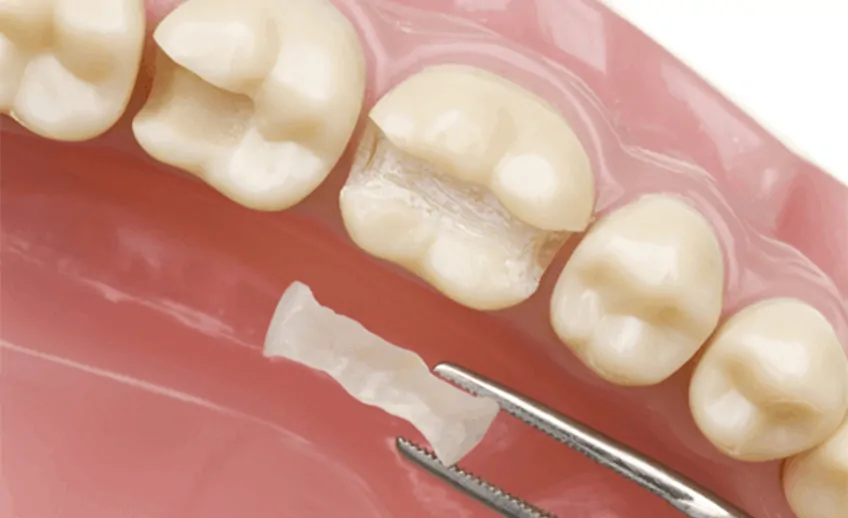 Dental Inlays