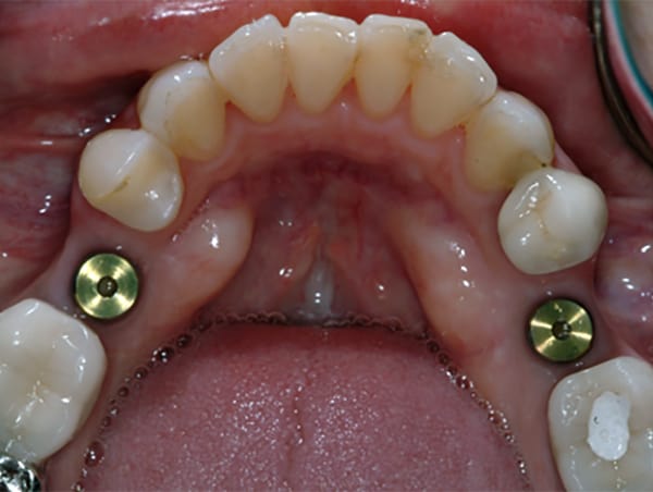 Misaligned Teeth Fixed with Crowns Before