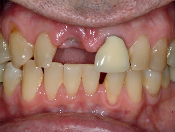 Missing and Misaligned Teeth Before