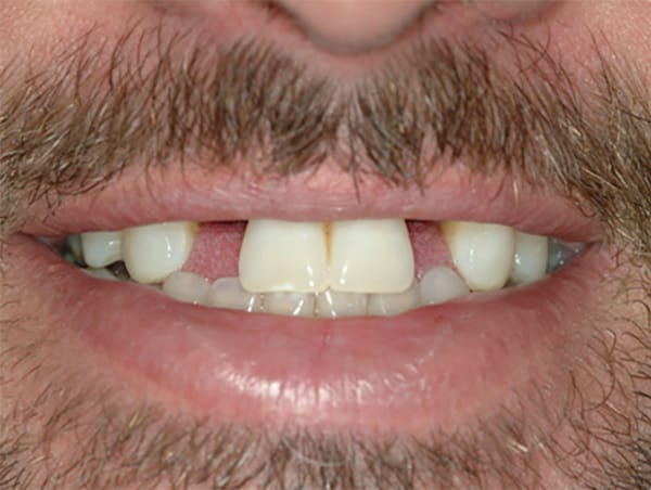 Restoring Missing Teeth Before