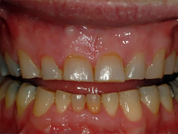 Severely Worn Teeth Before